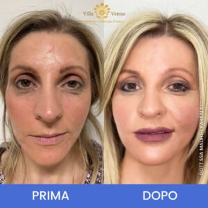 Rinofiller naso labbra foto prima e dopo