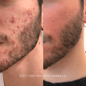 acne viso prima e dopo
