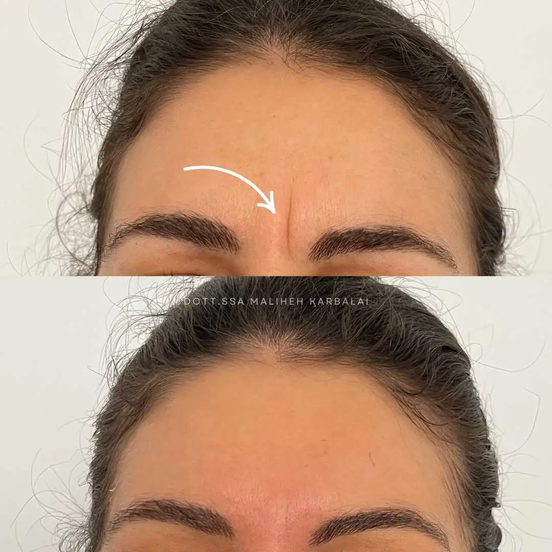 Botox glabellare rughe del leone prima e dopo &ndash; Villa Venus