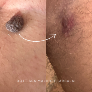 fibroma pendulo rimozione