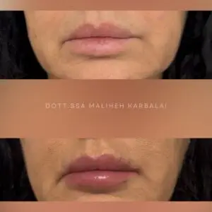 filler labbra perugia empoli arezzo