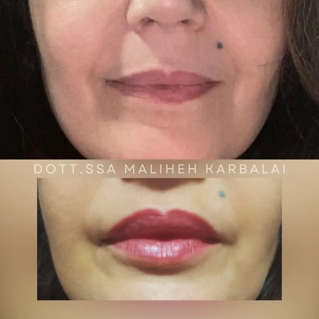 Filler labbra prima e dopo Villa Venus