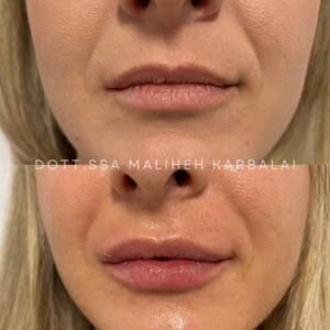 filler labbra prima e dopo