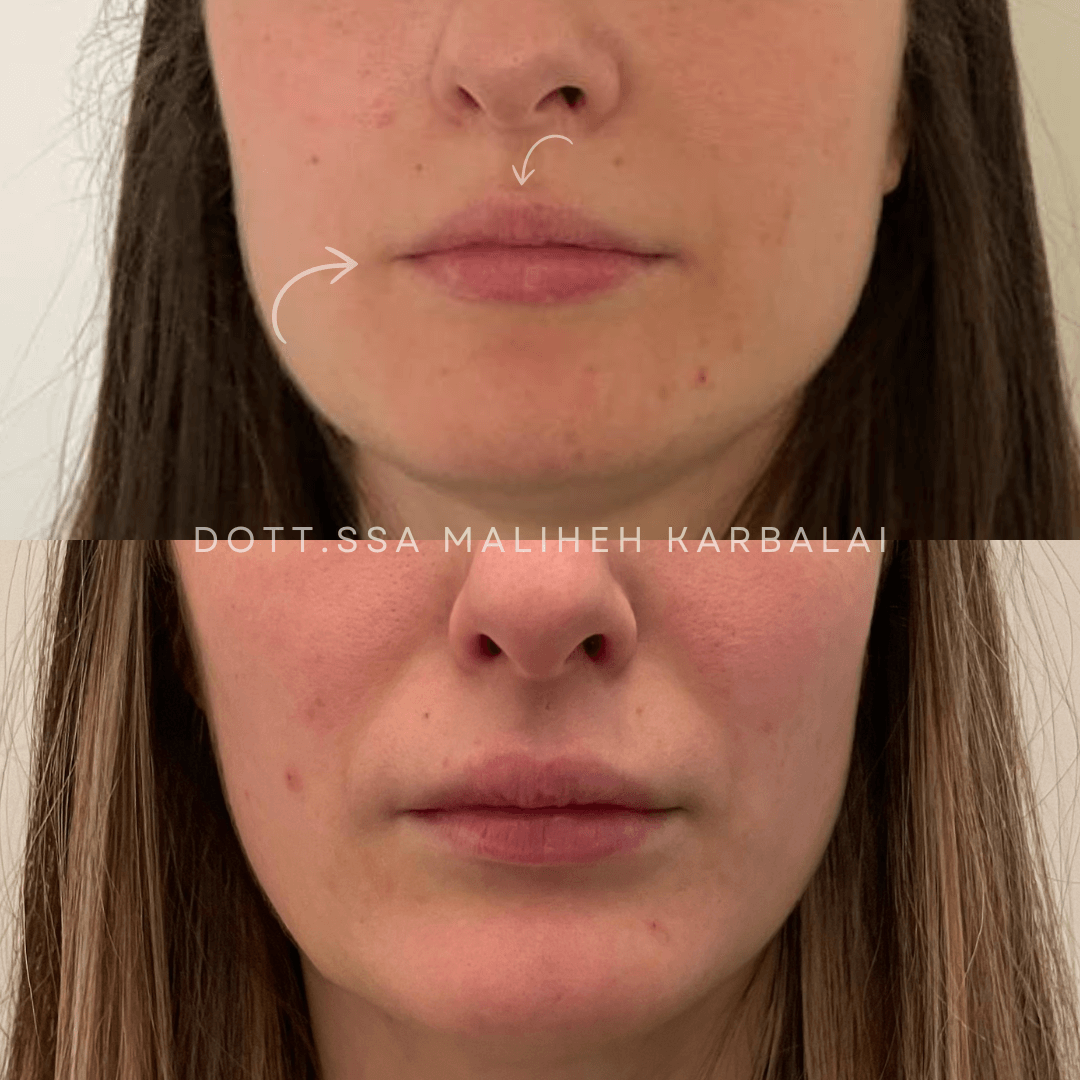 Filler labbra stile Russian Lips – Villa Venus