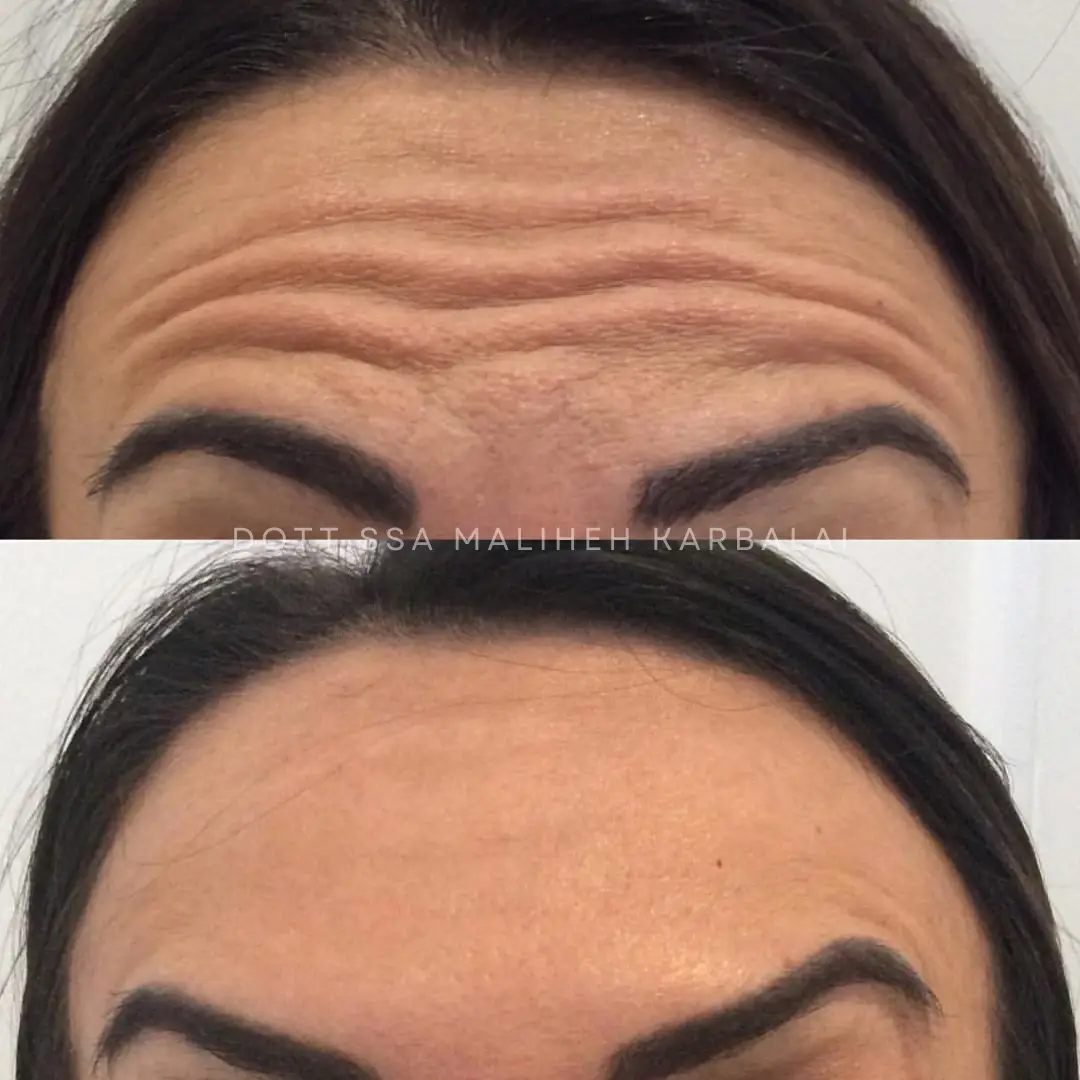 Botox fronte prima e dopo Villa Venus