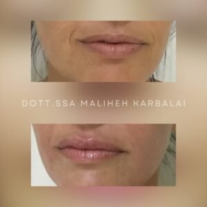 Filler labbra acido ialuronico prima dopo perugia empoli arezzo