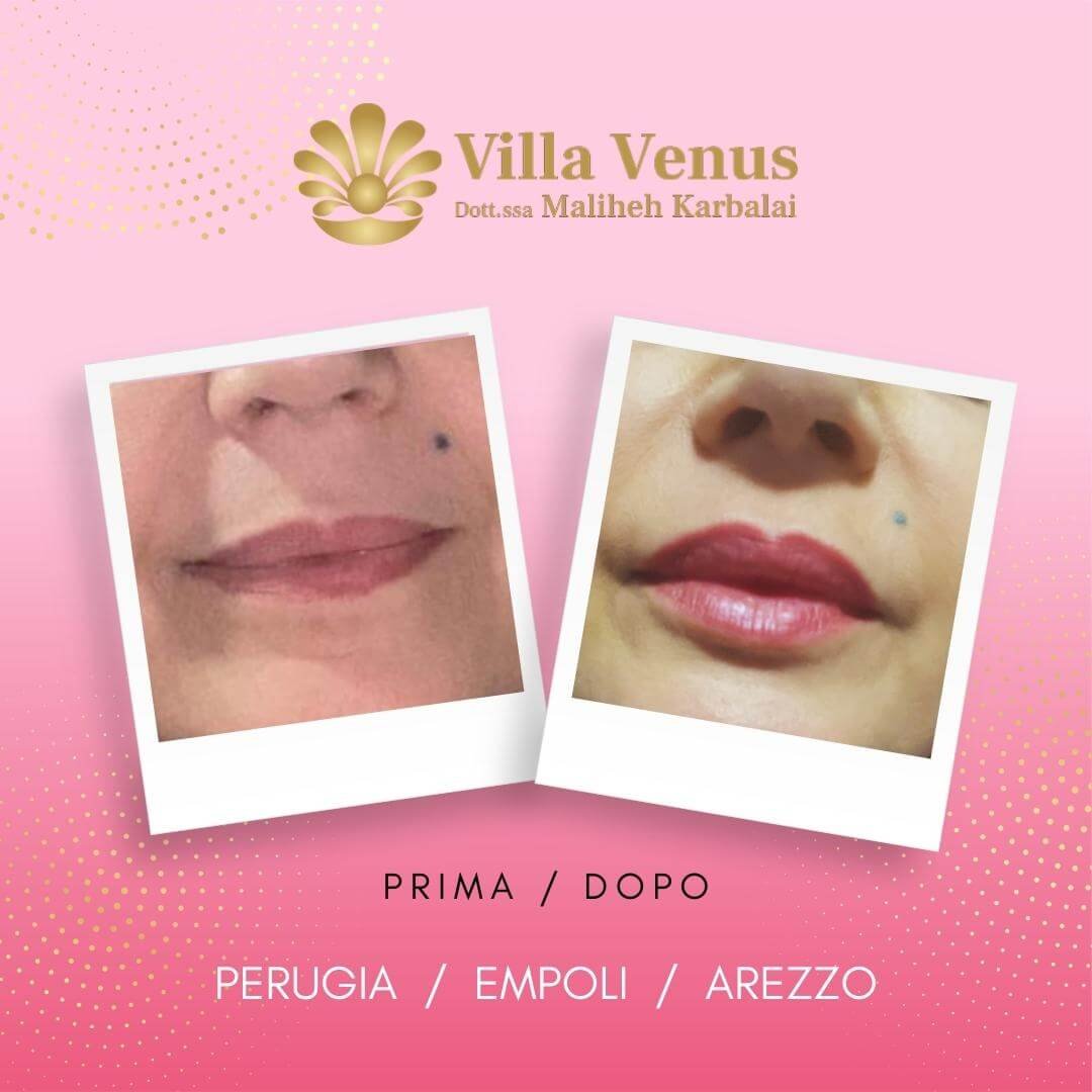 Aumento naturale del volume labiale