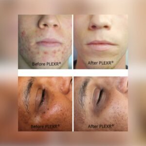 laser al plasma prima e dopo