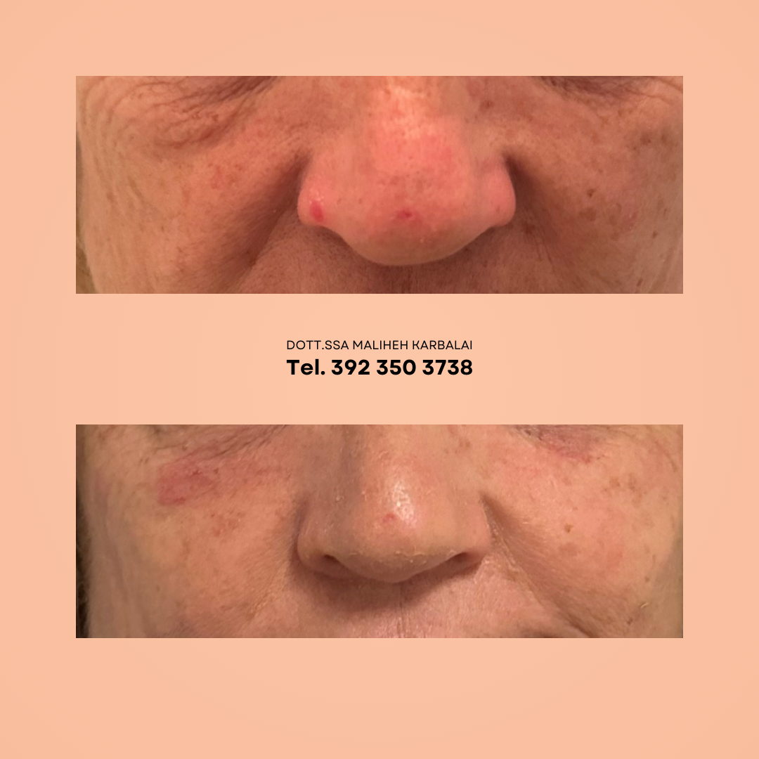 Miglioramento della texture nasale