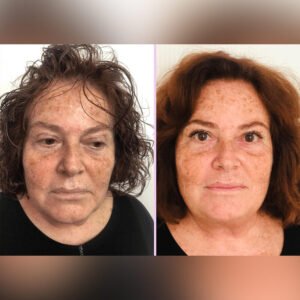 macchie al viso prima e dopo