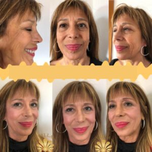 ringiovanimento del viso prima e dopo