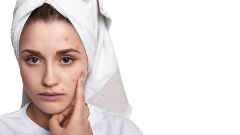 rimozione acne perugia empoli arezzo
