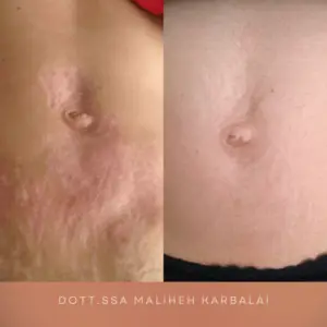 rimozione smagliature a Perugia Empoli e Arezzo