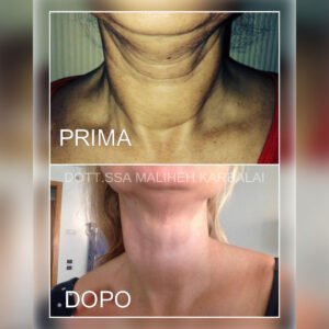 ringiovanimento del collo